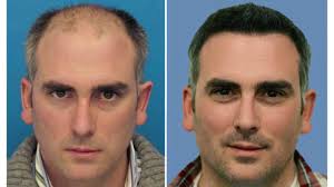 دراسة: زراعة الشعر تظهر الرجال أكثر جاذبية وأصغر سنا